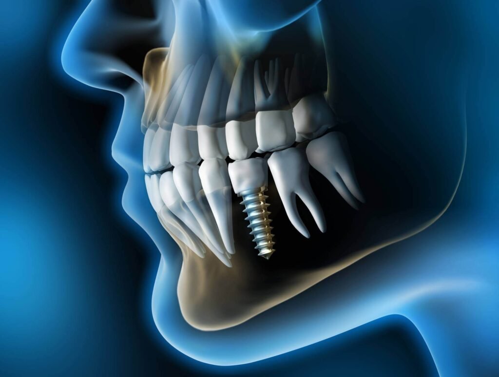 It's essential to note that the cost of dental implants can vary based on geographic location. Factors such as regional labor costs and the availability of specialized services can influence the overall expenses. Consider consulting with local professionals to get a more accurate estimate for your specific area.