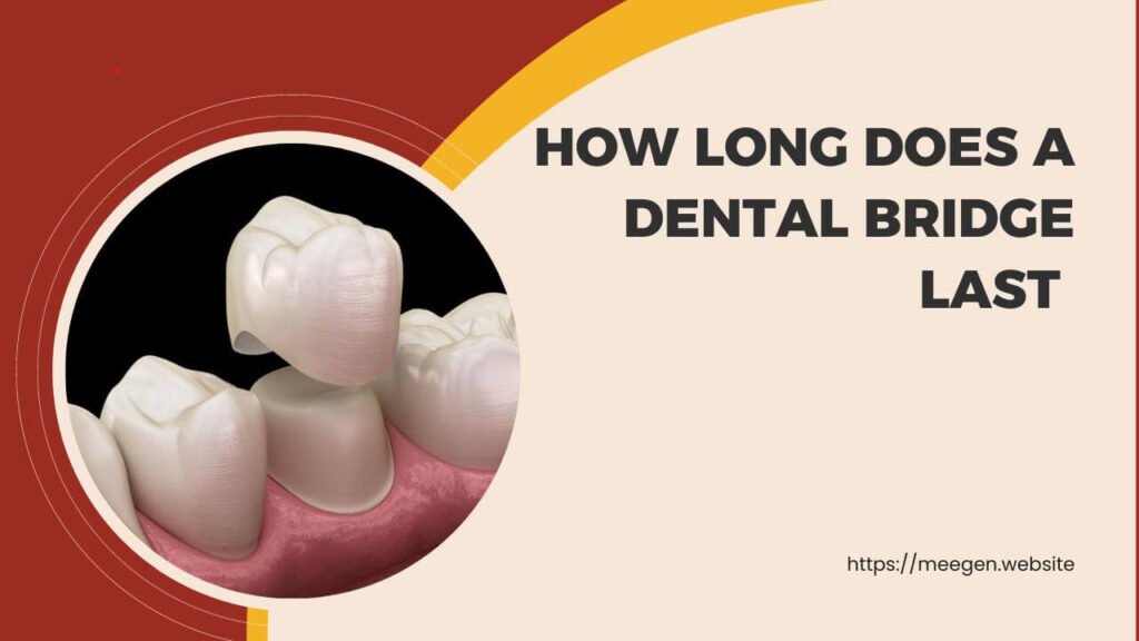 How long does a dental bridge last 