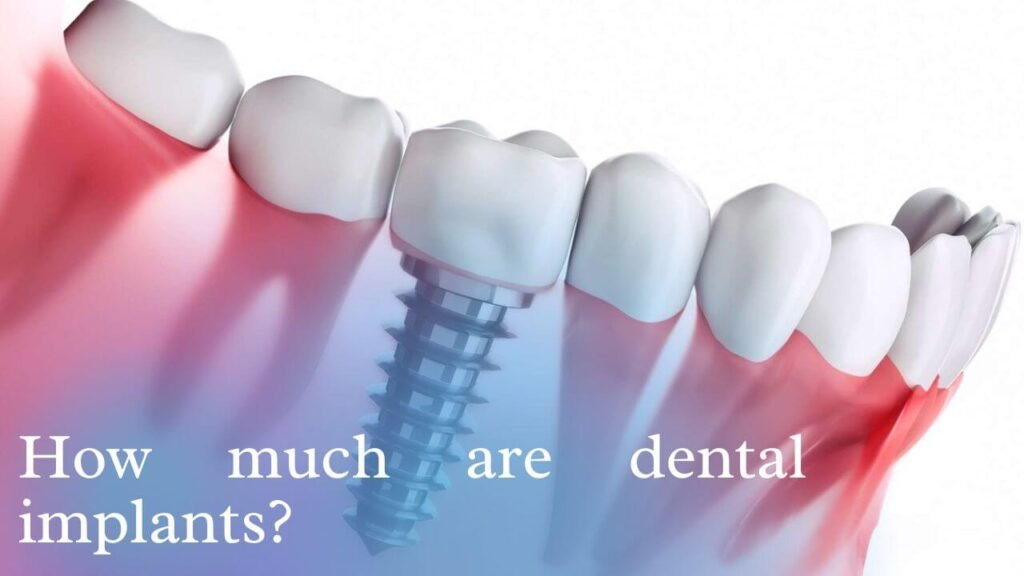 How much are dental implants